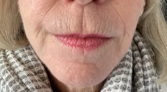 Close-up of woman's wrinkles and lines around mouse before Tixel