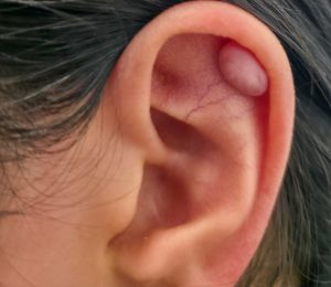 earlobe keloid