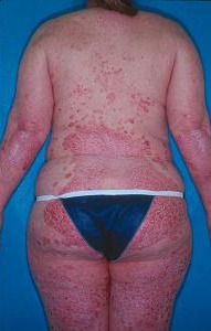 Severe psoriasis