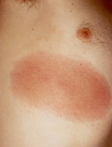 Image of Erythema migrans