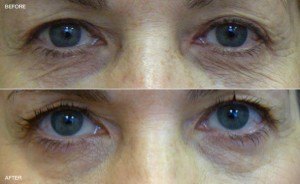 Pelleve: before and after lower eyelid skin tightening