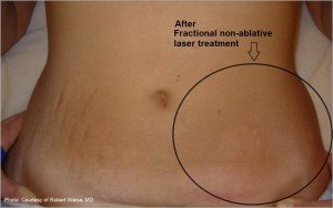 Results of non-invasive fractional laser treatment of stretch marks