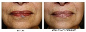 Venous lake before and after two laser treatments