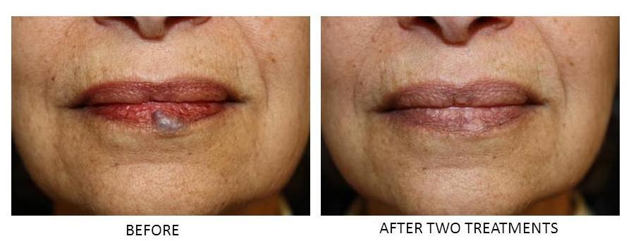 Lip cheap laser treatment