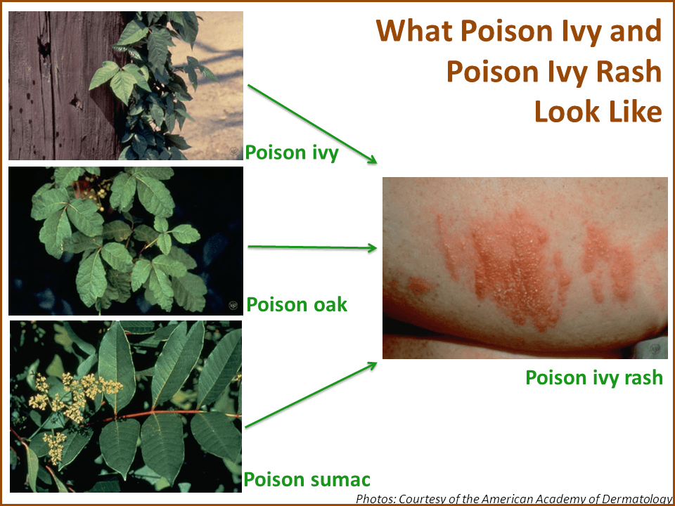 show me poison ivy rash