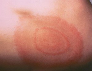 Image of Erythema migrans - bulls eye
