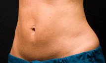 After CoolSculpting Procedure