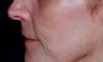 One month after laser resurfacing
