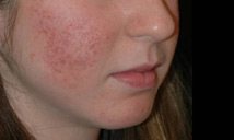 Acne scarring