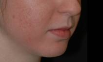 After a series of fractional laser treatments (Fraxel re:store)