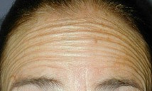 Forehead wrinkle lines