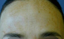 After treatment with botulinum toxin