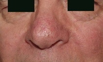 After one laser treatment
