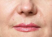 After Juvederm