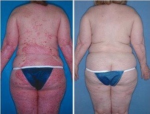 Photos of psoriasis pre and post Remicade treatment