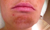 Before melasma treatment of chin