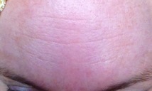 After Melasma treatment