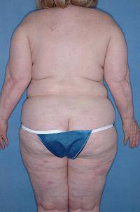 Psoriasis after Remicade treatment