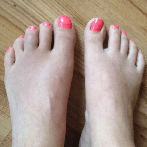 Image of psoriatic arthritis 