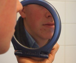 Teen acne treatment