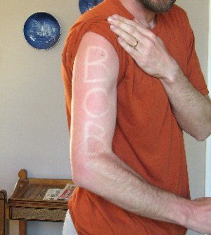 Sunburn on marathon's day