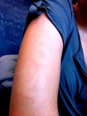 Sun damage on triathlete a year later